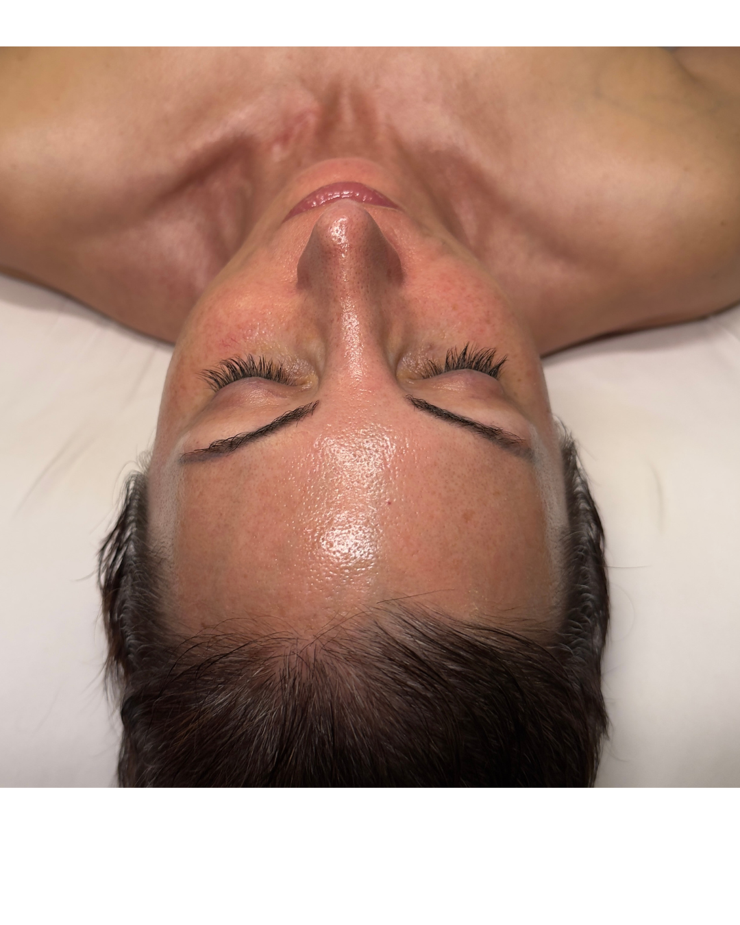 January Is for Hydrafacials