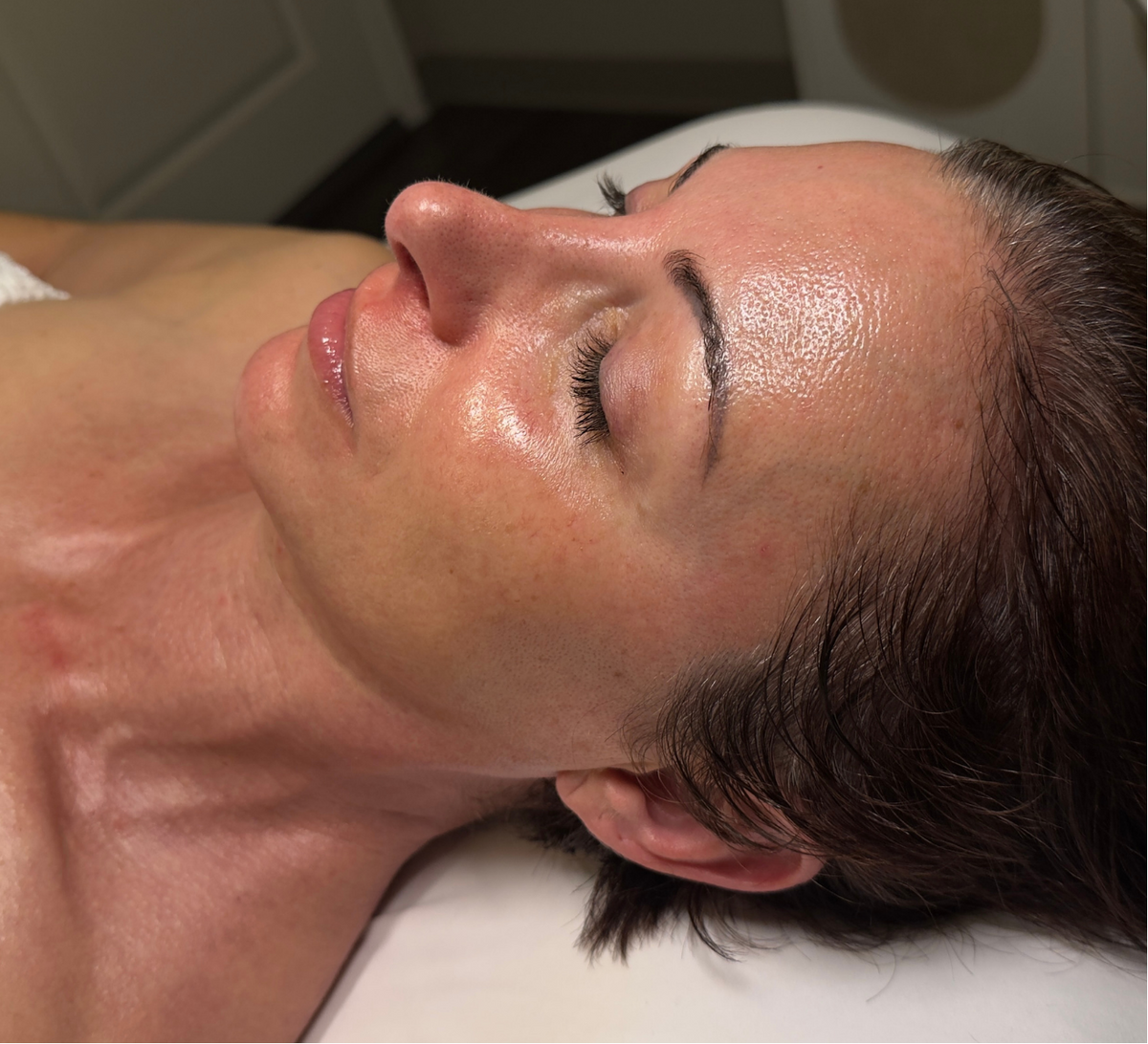 Signature Facial treatment result at New You Aesthetic in Marietta, GA